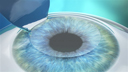 LASIK is reshaping the cornea