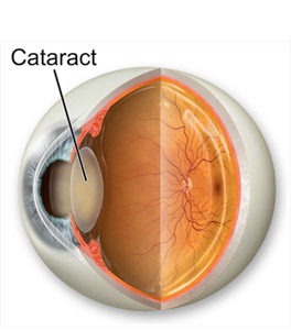 view of a cataract shown as a cross section of the eye